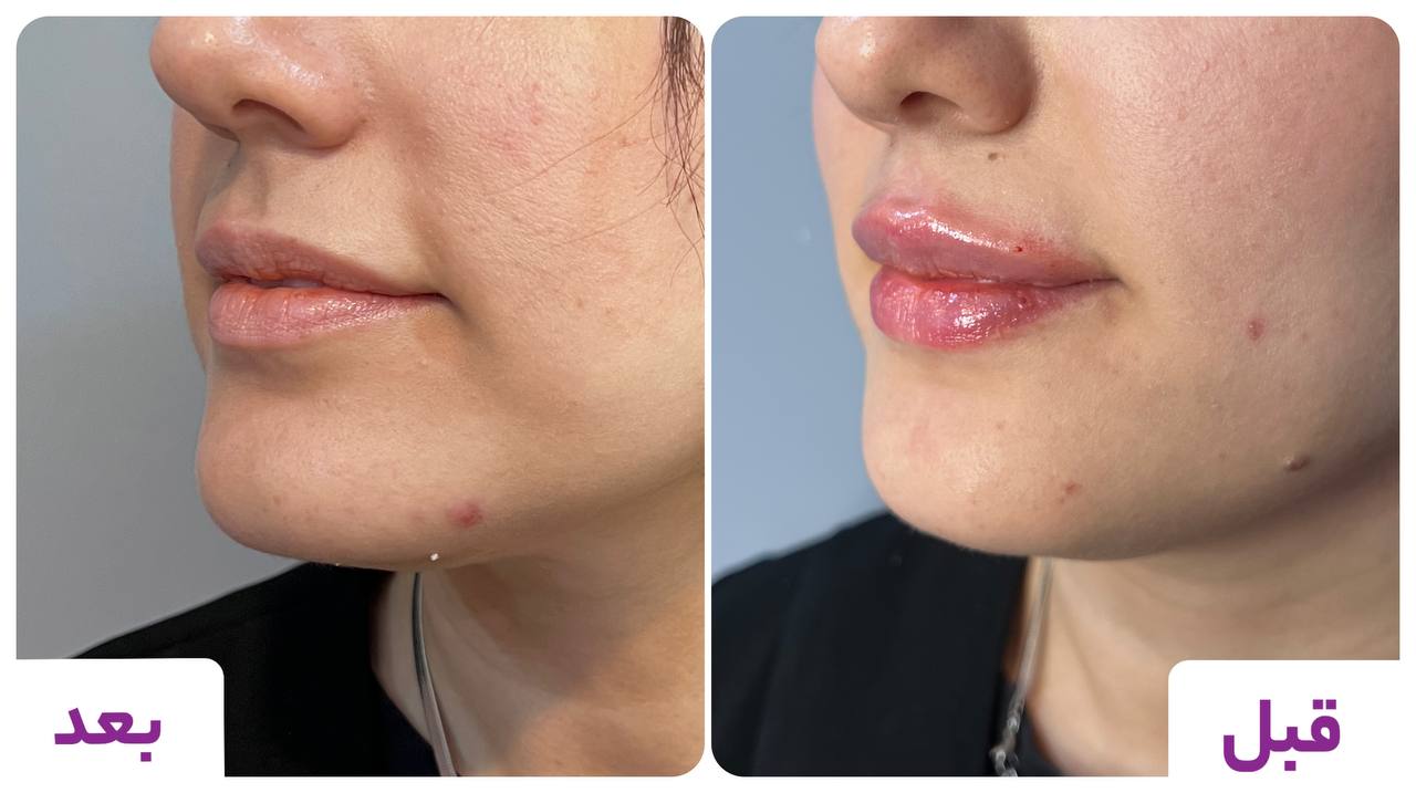 تصاویر قبل و بعد از تزریق ژل