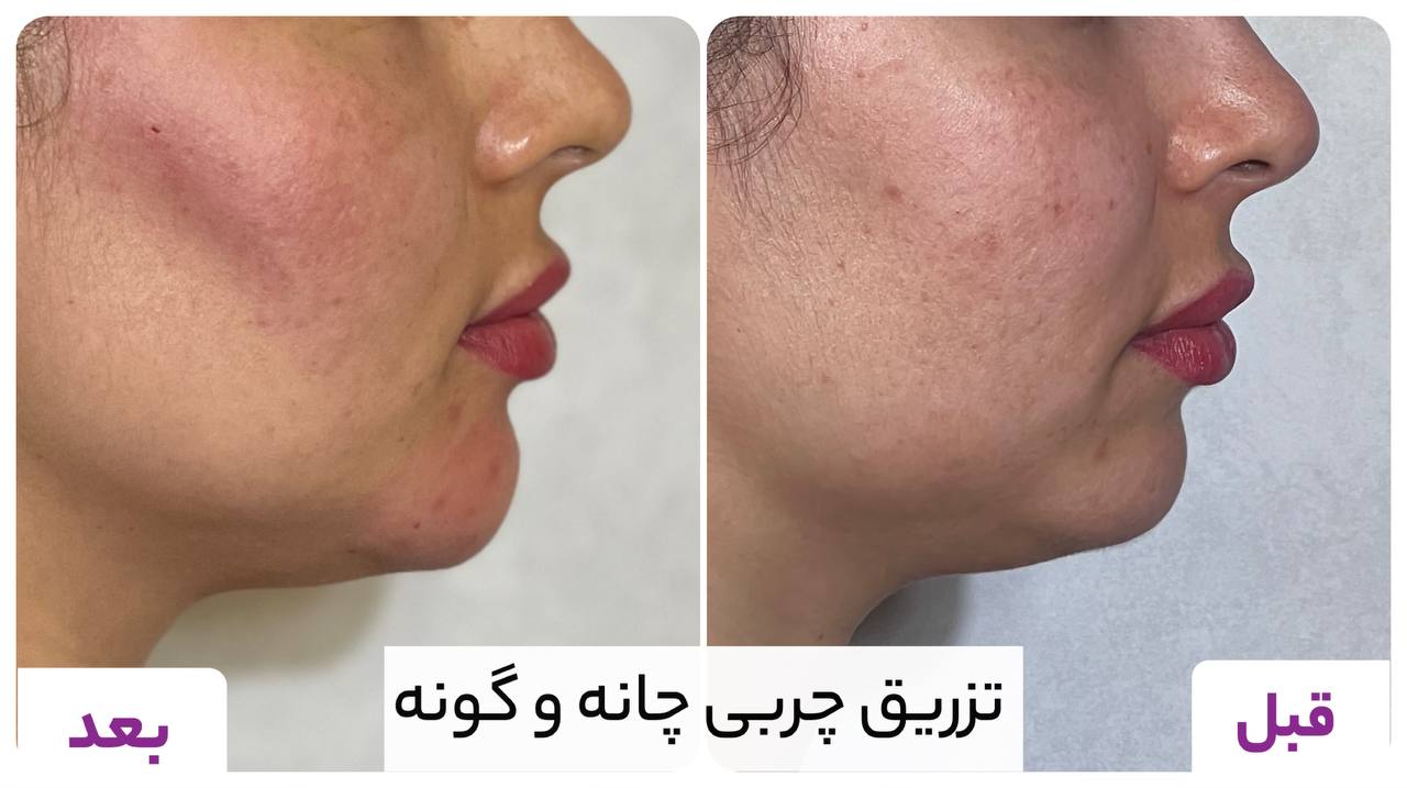 تصاویر قبل و بعد از تزریق ژل