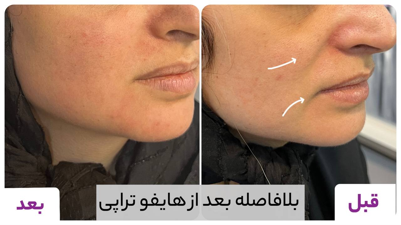 تصاویر قبل و بعد از تزریق ژل