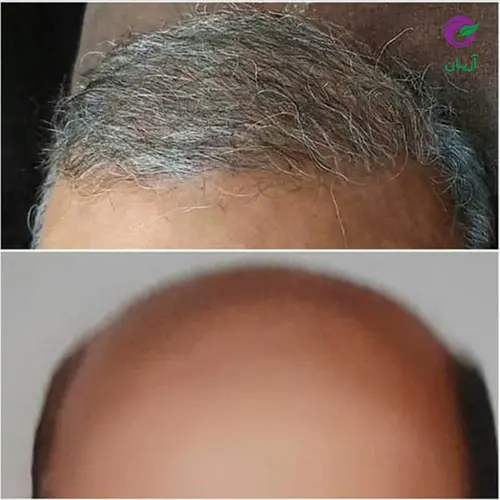 Photos before and after hair transplant