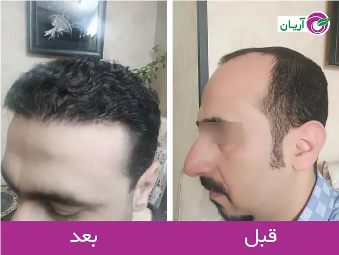 Photos before and after hair transplant
