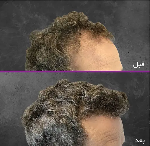 Photos before and after hair transplant