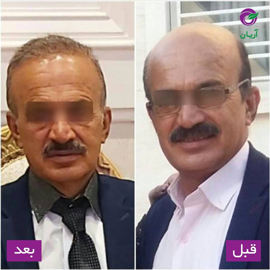 Photos before and after hair transplant