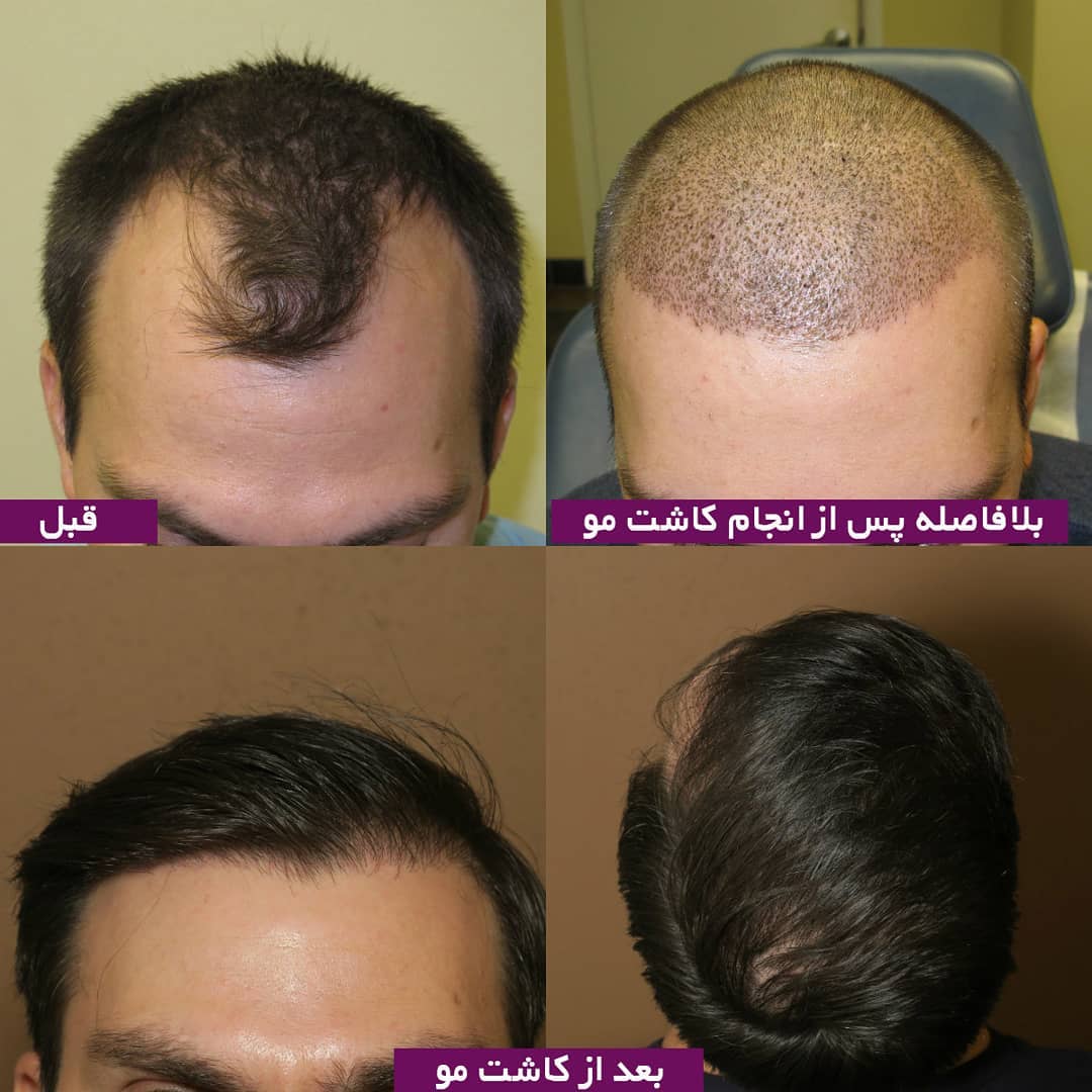 Photos before and after hair transplant