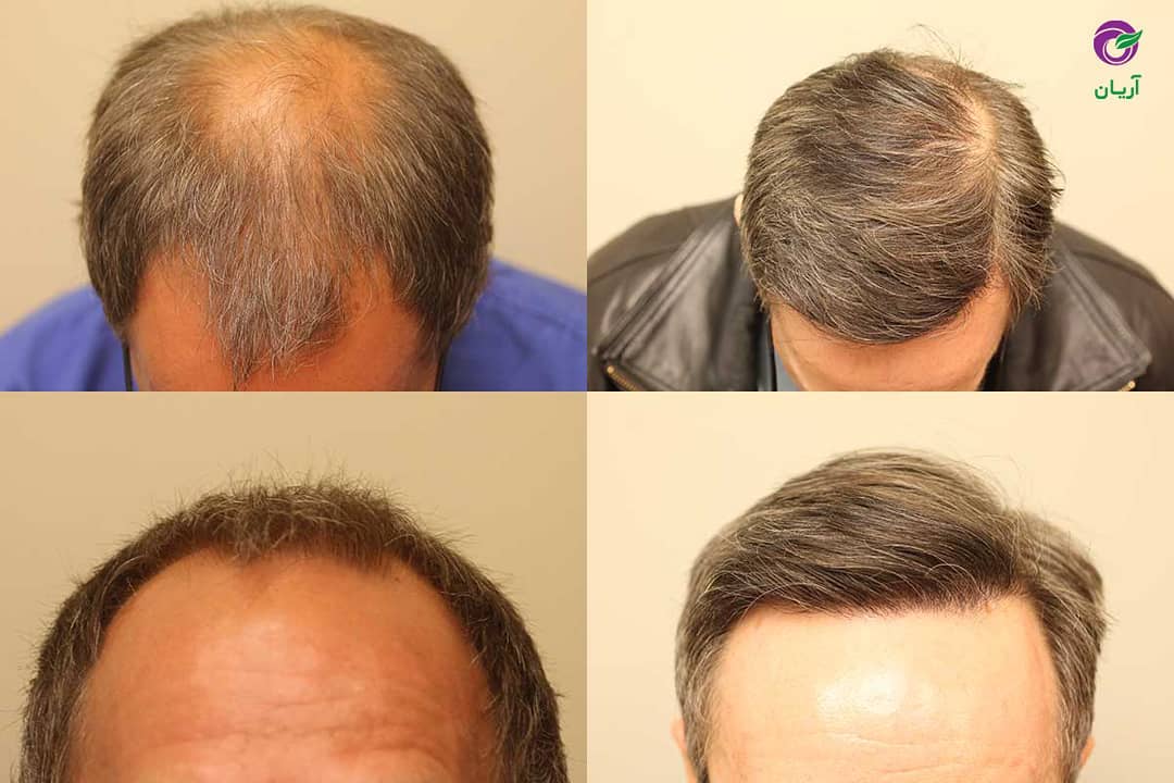 Photos before and after hair transplant