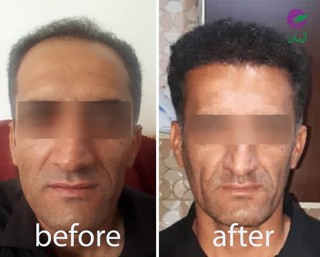 Photos before and after hair transplant