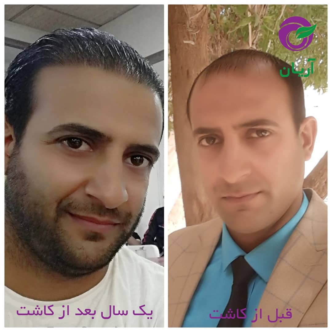 Photos before and after hair transplant