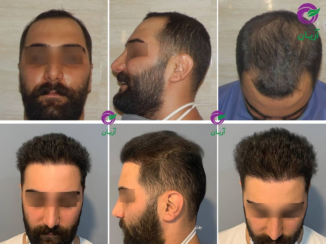 صور قبل وبعد زراعة الشعر
