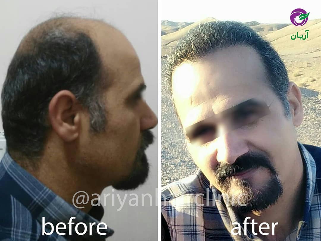 صور قبل وبعد زراعة الشعر