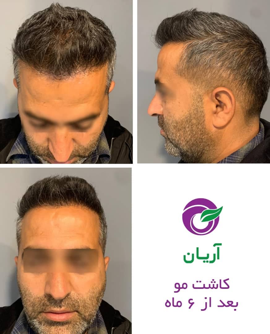 صور قبل وبعد زراعة الشعر