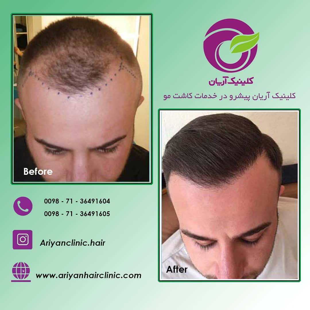 صور قبل وبعد زراعة الشعر