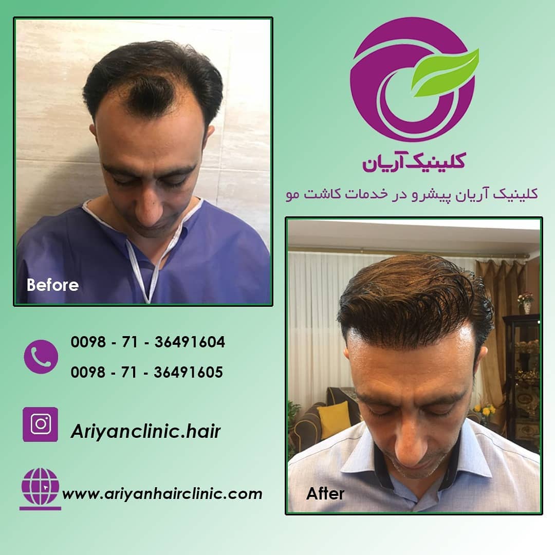 صور قبل وبعد زراعة الشعر