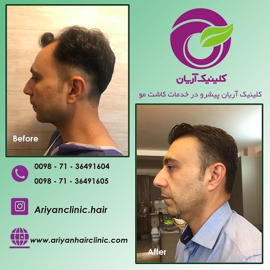 صور قبل وبعد زراعة الشعر