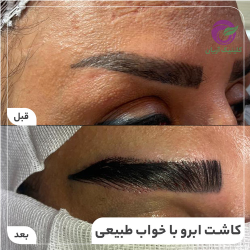 گالری فیلم کاشت ابرو