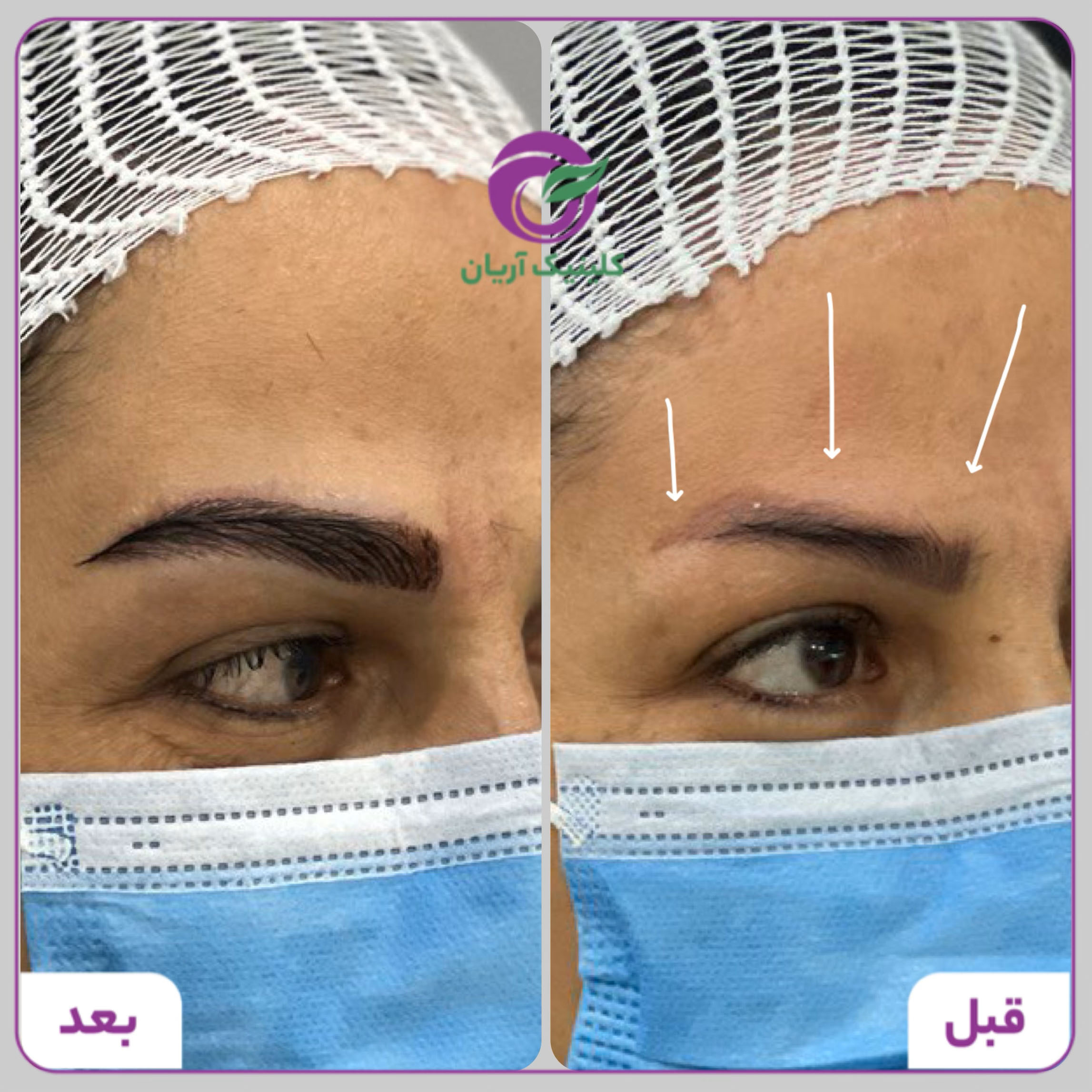 گالری فیلم کاشت ابرو