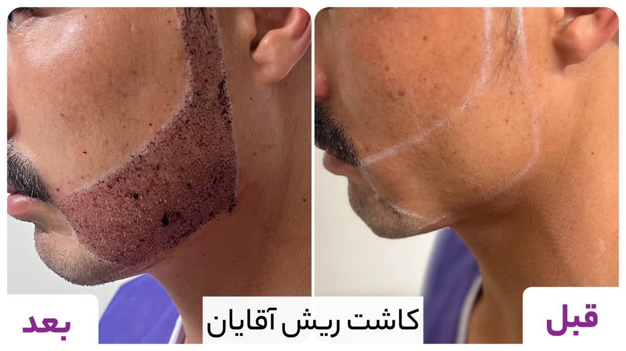 گالری کاشت ریش و سبیل