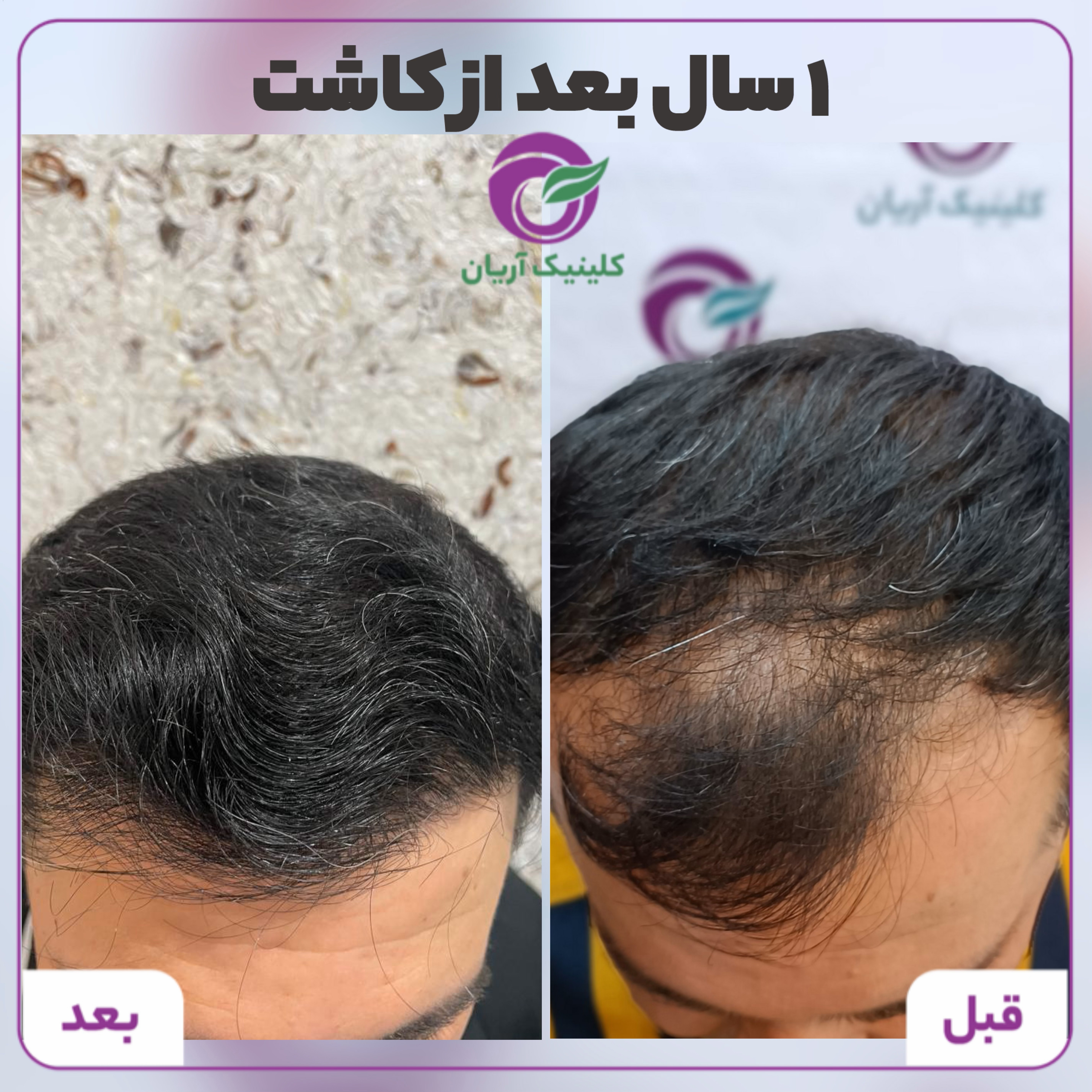 گالری کاشت مو 