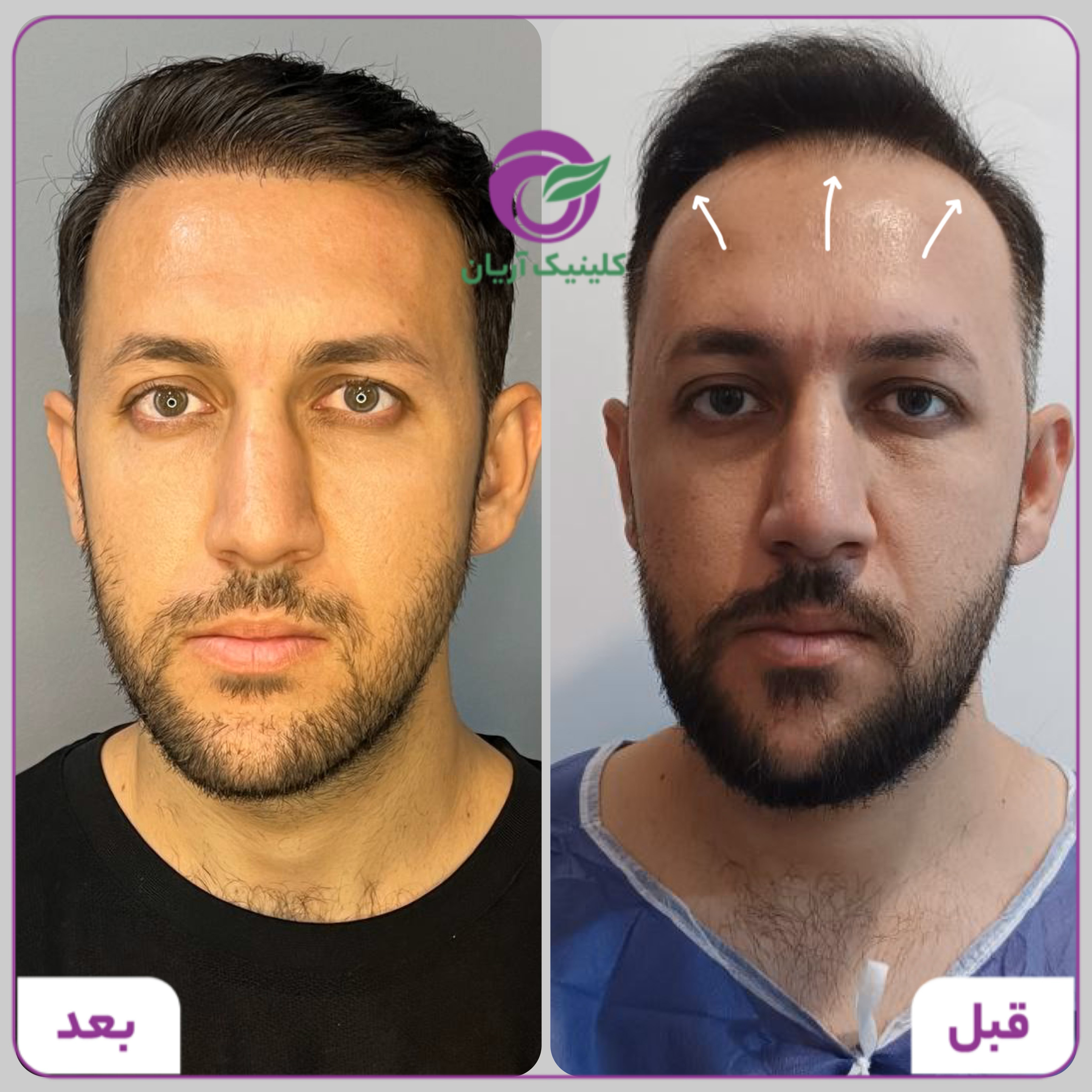 گالری کاشت مو 