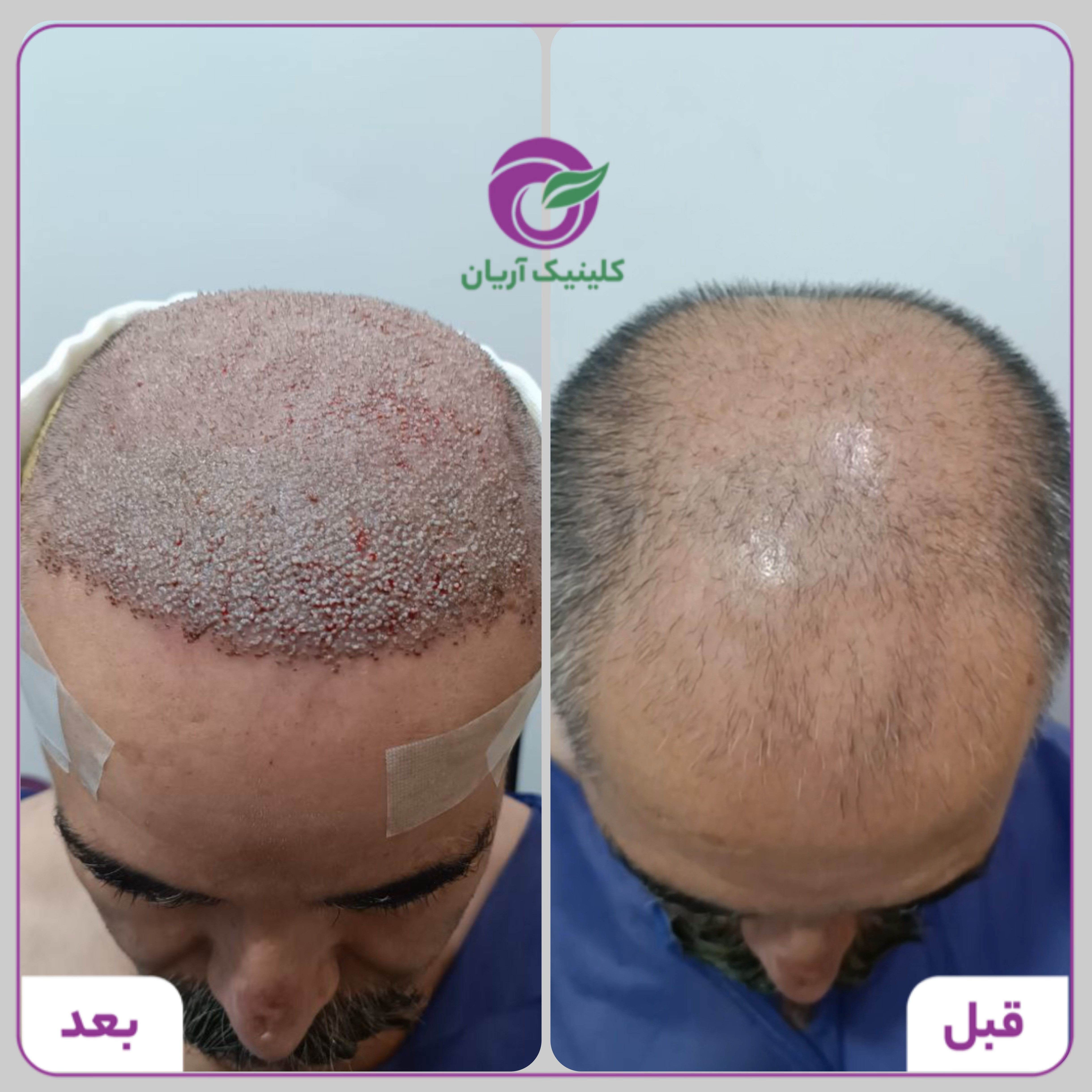 گالری کاشت مو 