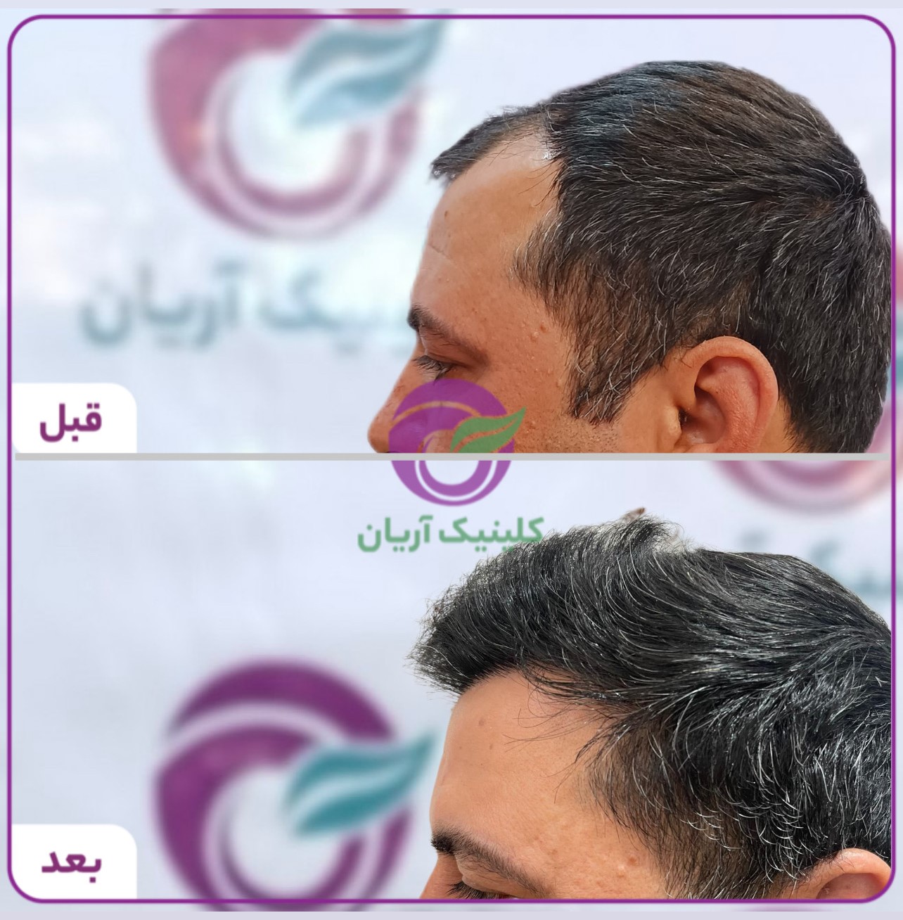 گالری کاشت مو 