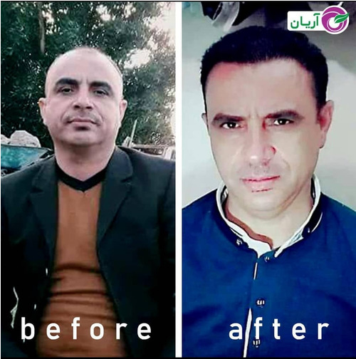گالری کاشت مو 