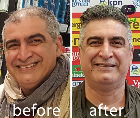 گالری کاشت مو 