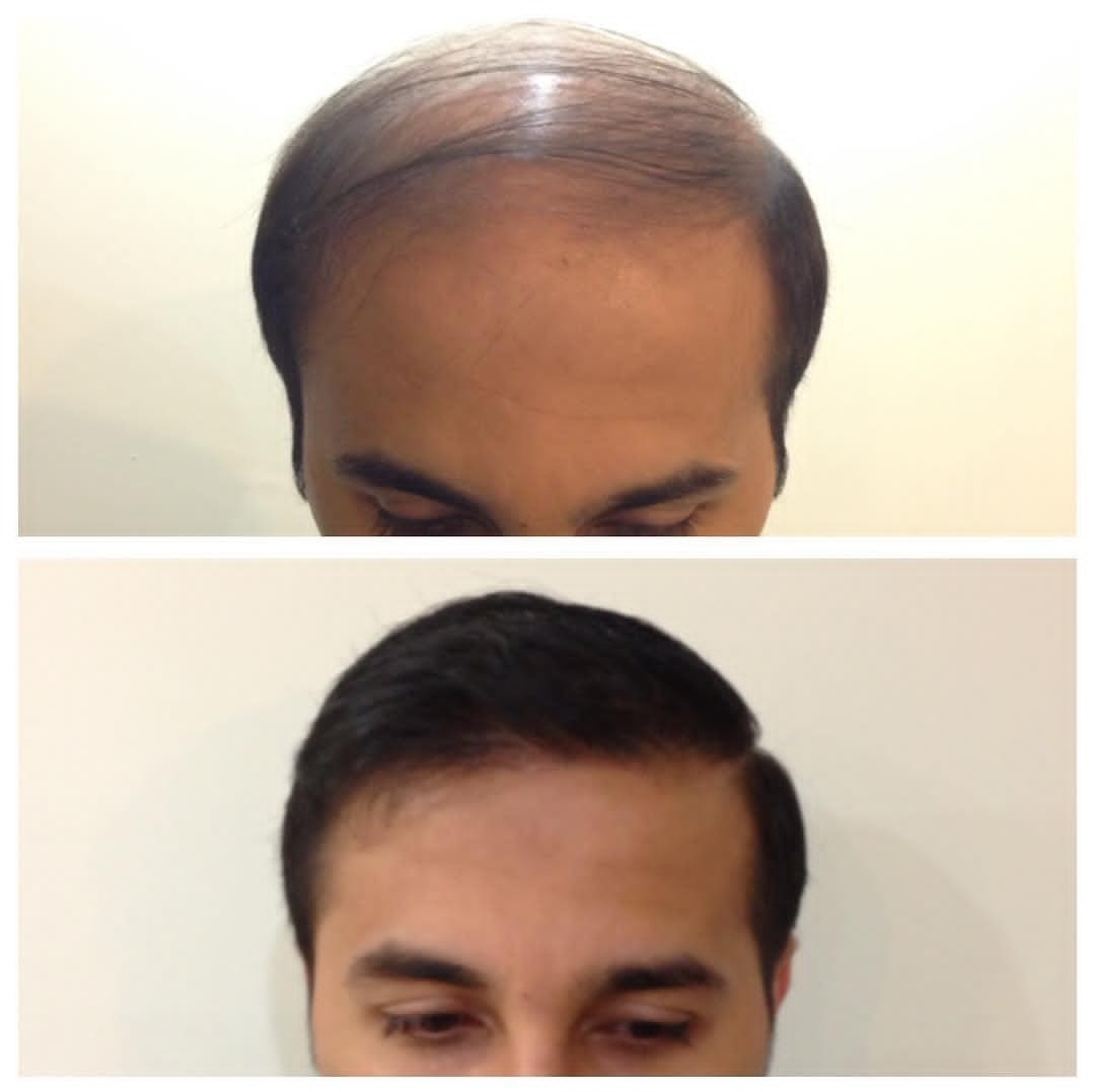 گالری کاشت مو 