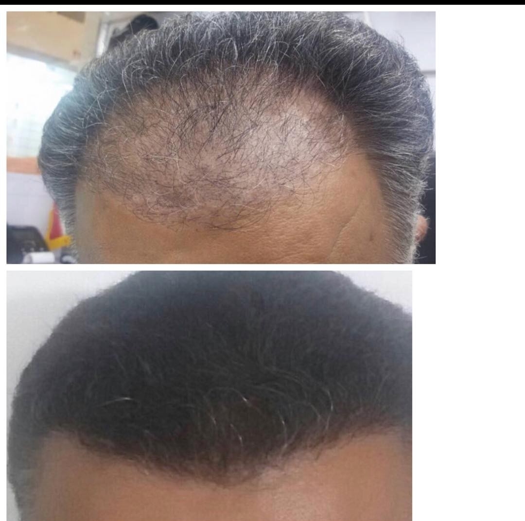 گالری کاشت مو 