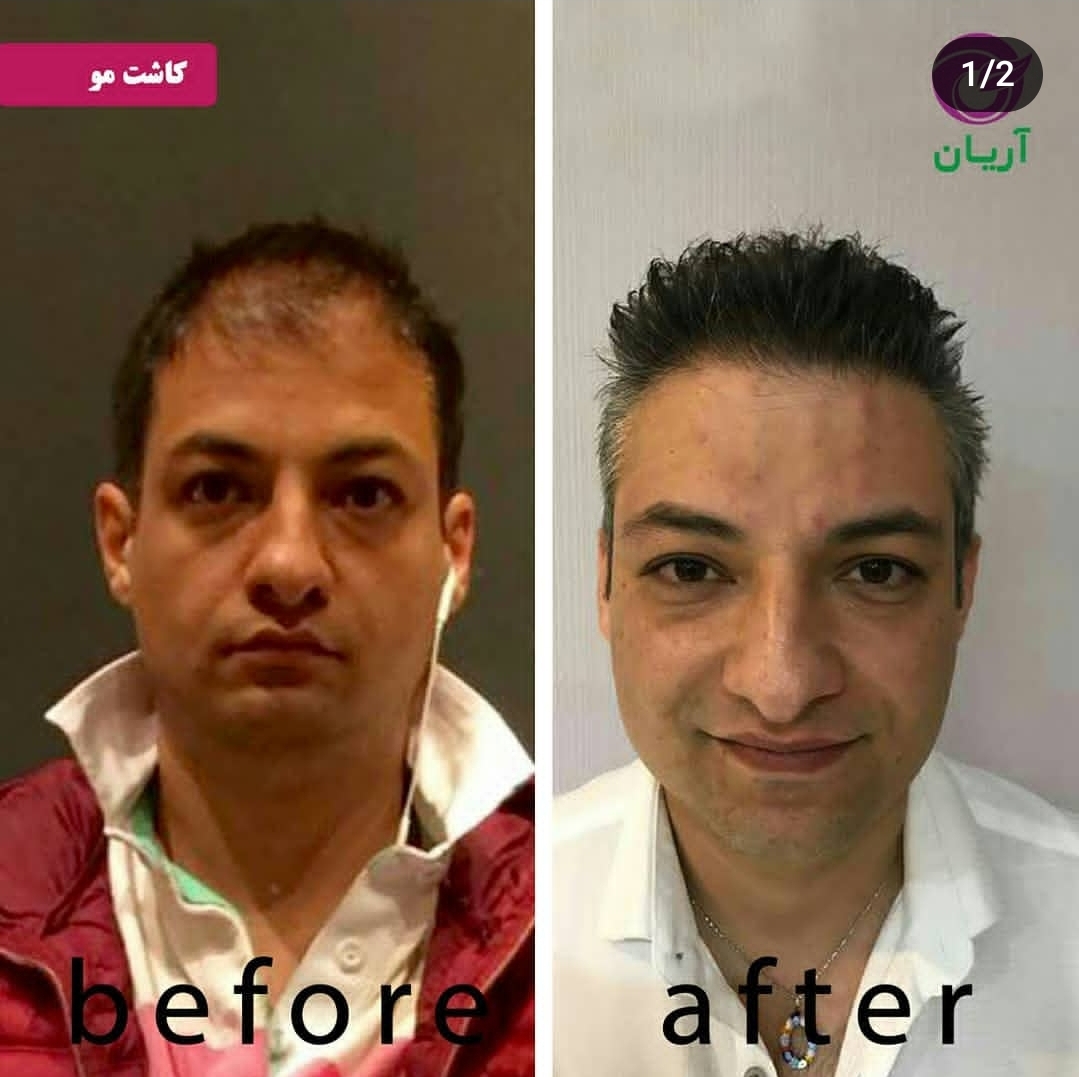 گالری کاشت مو 