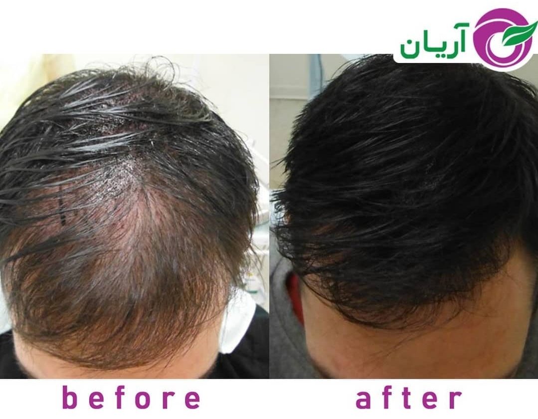 گالری کاشت مو 