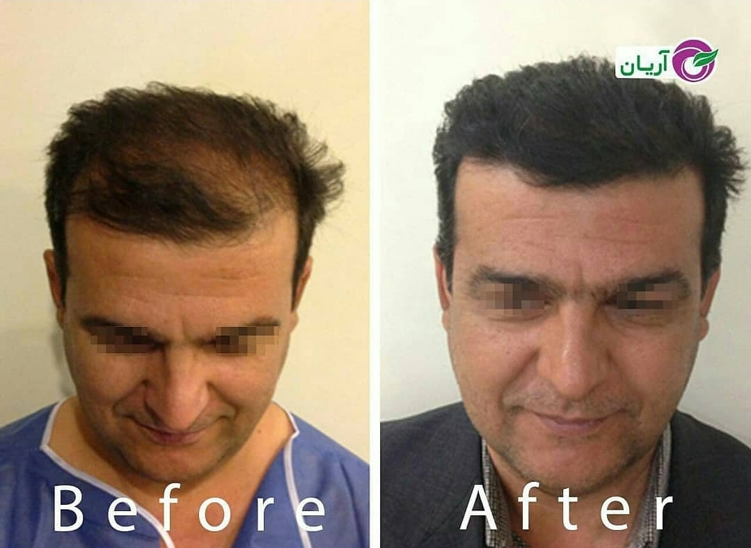 گالری کاشت مو 