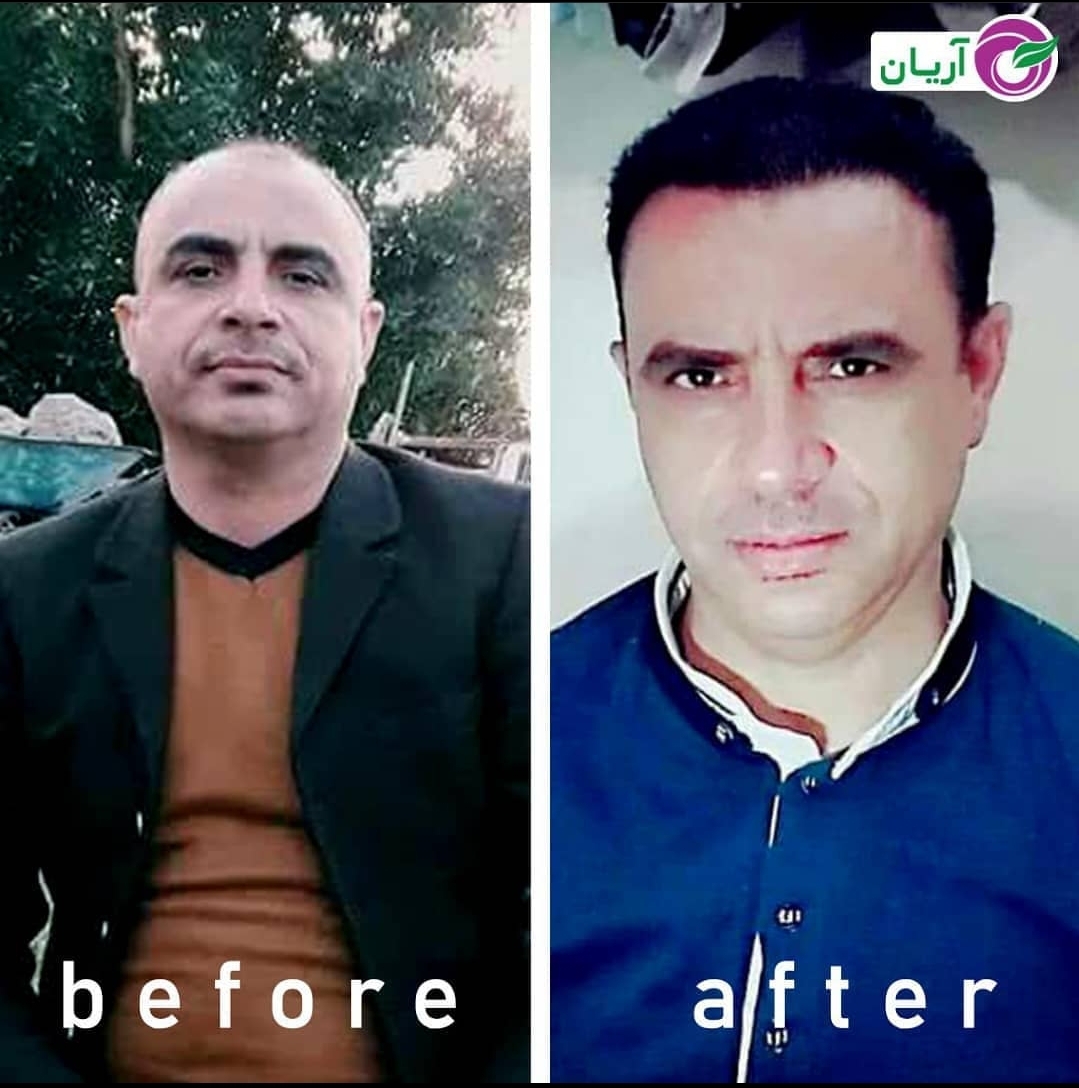 گالری کاشت مو 