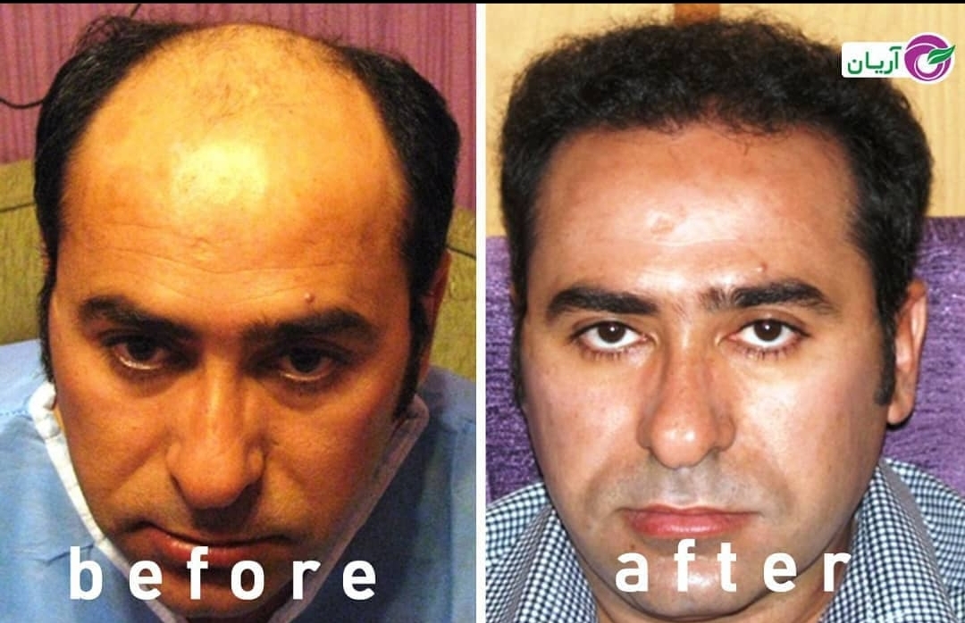 گالری کاشت مو 