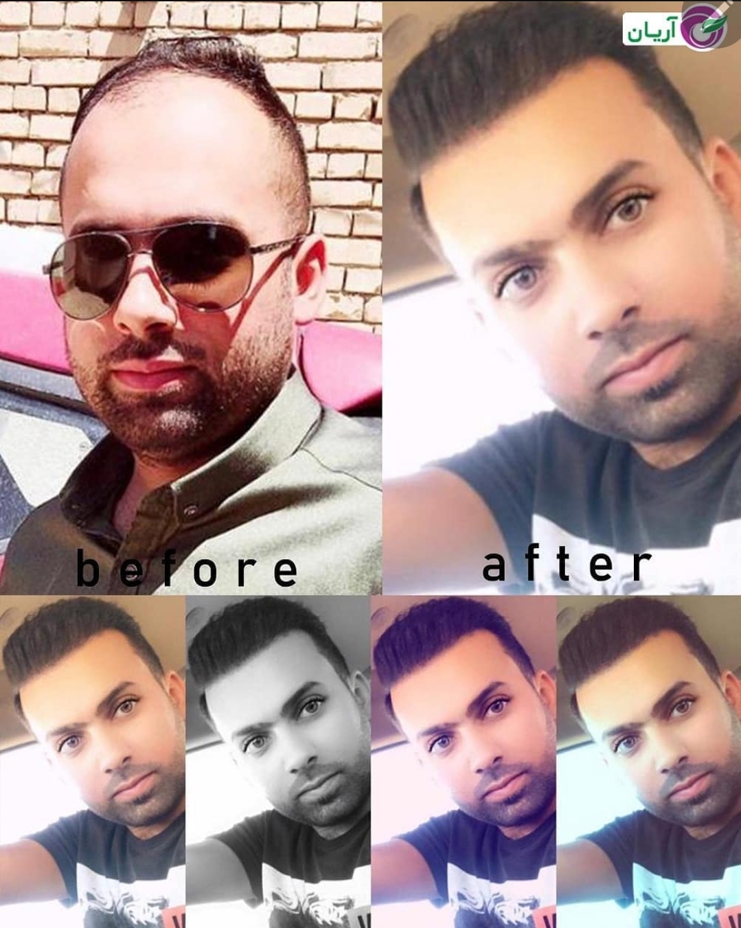 گالری کاشت مو 