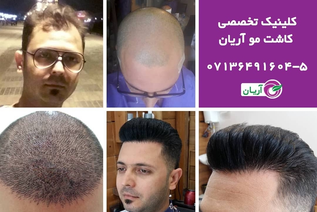 گالری کاشت مو 