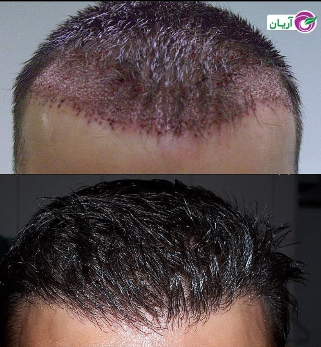 گالری کاشت مو 