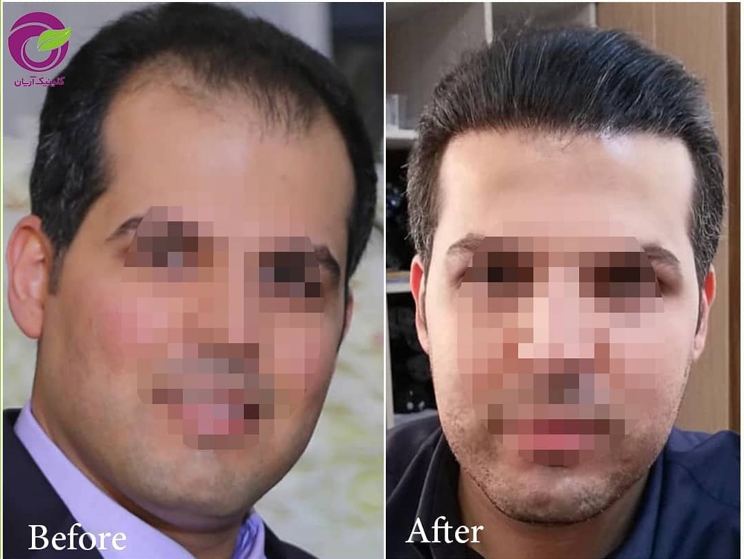 گالری کاشت مو 