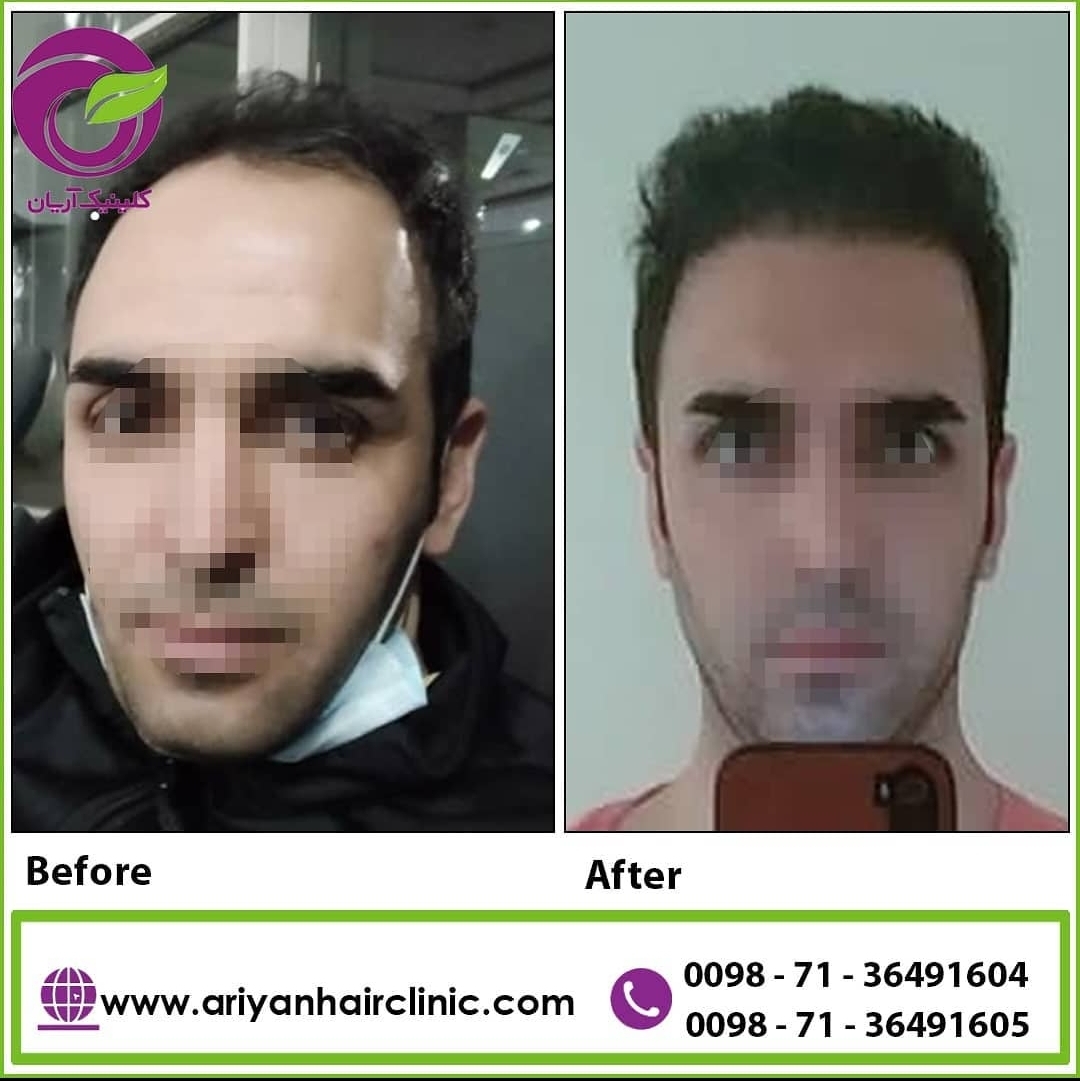 گالری کاشت مو 