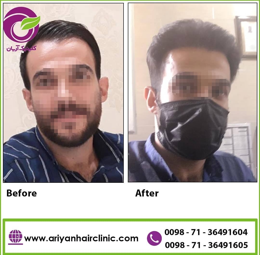 گالری کاشت مو 