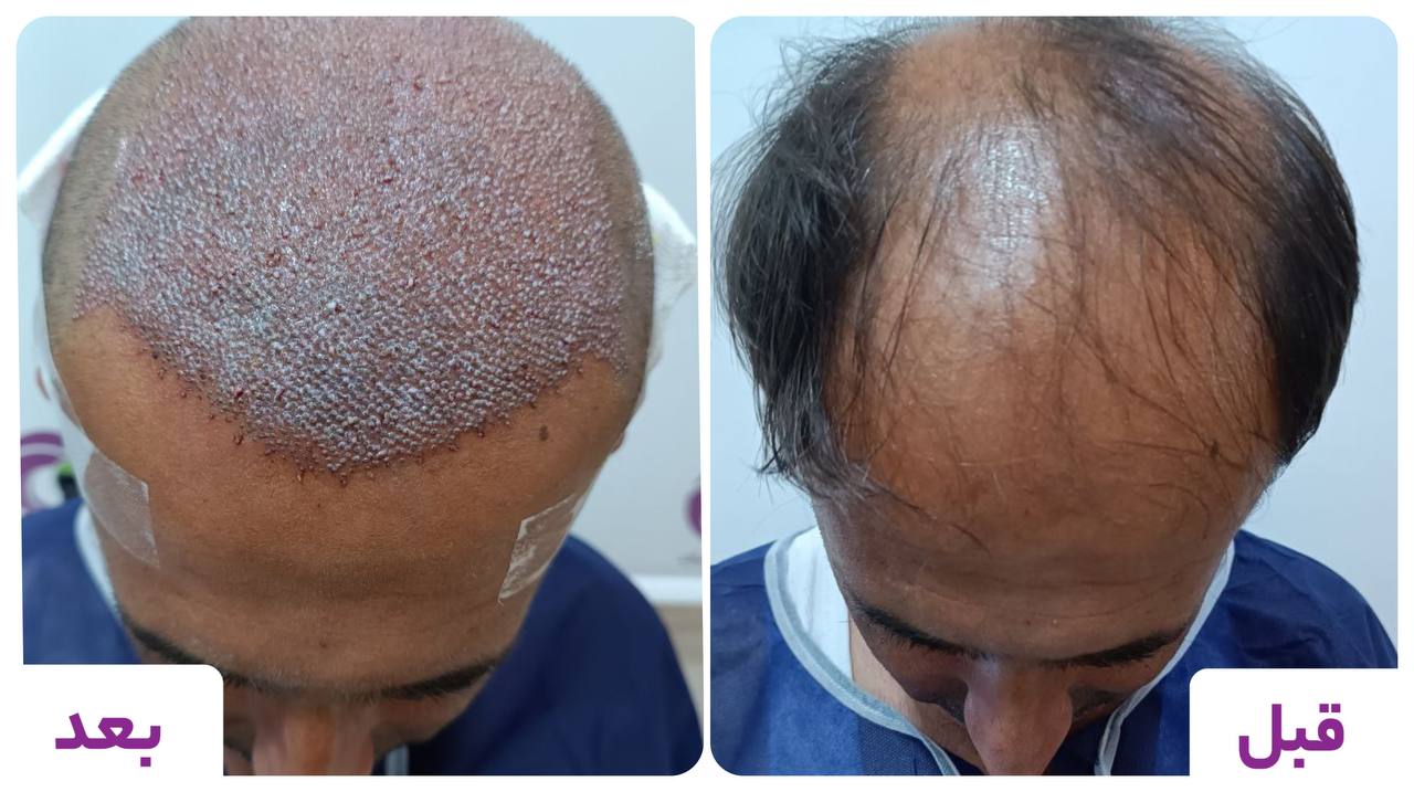 گالری کاشت مو 