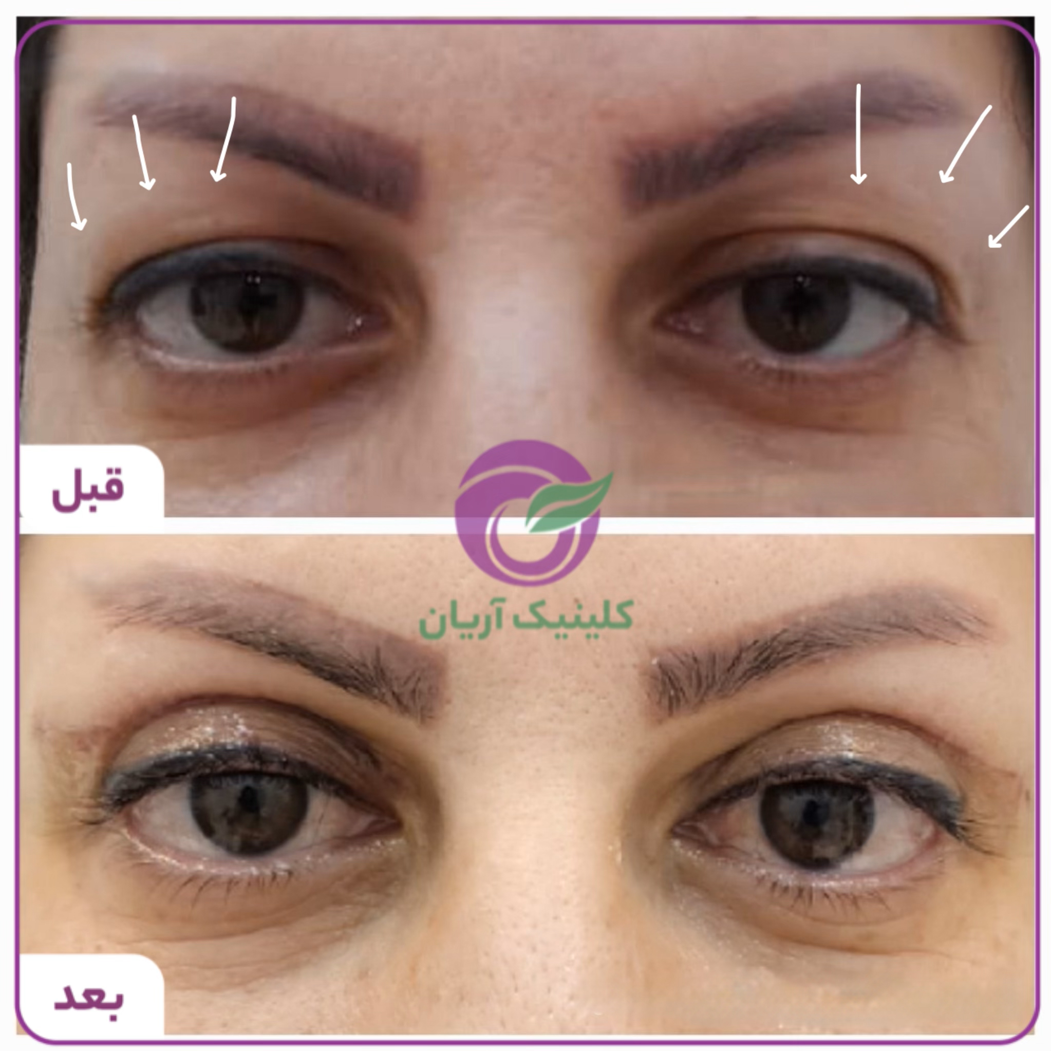 گالری بلفاروپلاستی/ جراحی پلک