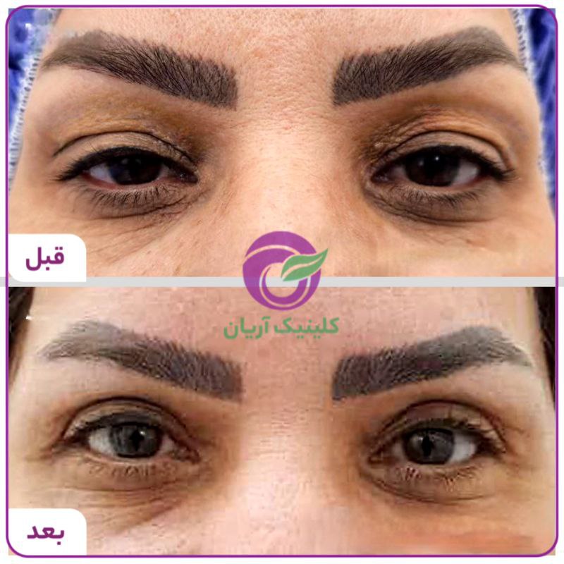 گالری بلفاروپلاستی/ جراحی پلک