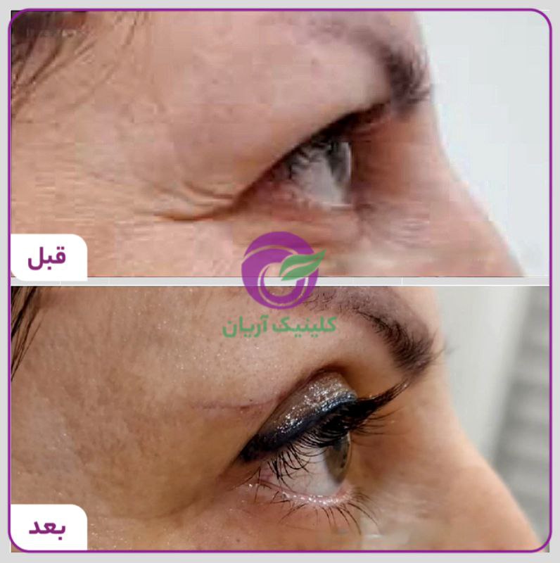 گالری بلفاروپلاستی/ جراحی پلک