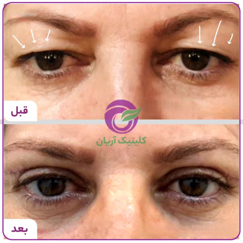 گالری بلفاروپلاستی/ جراحی پلک