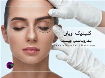 گالری بلفاروپلاستی/ جراحی پلک