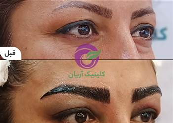 گالری فیلم کاشت ابرو