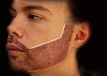 گالری کاشت ریش و سبیل