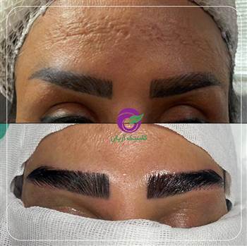 گالری عکس کاشت ابرو