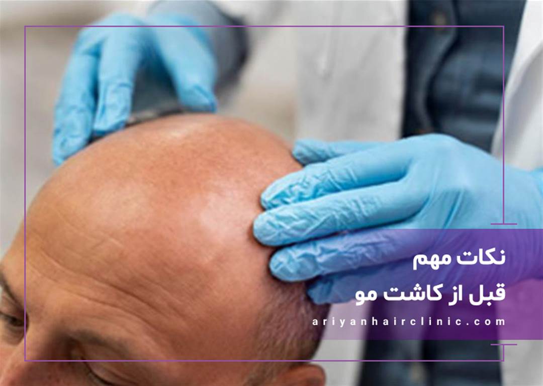 نکات مهم قبل از کاشت مو