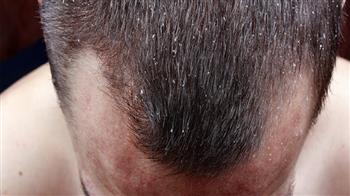 علت پوسته شدن سر بعد از کاشت مو چیست؟